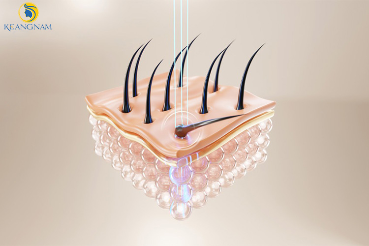 Dịch vụ triệt lông vĩnh viễn tại Thẩm Mỹ Keangnam Sóc Sơn