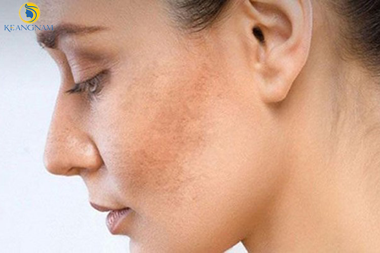 Thẫm Mỹ Keangnam Sóc Sơn tư vấn cách tạm biệt làn da sạm xỉn màu