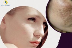 Thiamidol là gì? Nó tác dụng gì trong điều trị nám từ sâu bên trong?