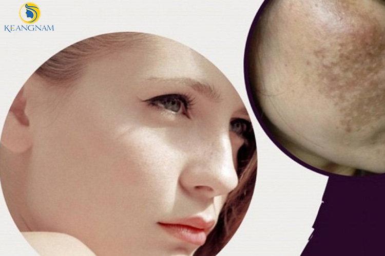 Thiamidol là gì? Nó tác dụng gì trong điều trị nám từ sâu bên trong?