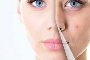 Dịch vụ điều trị mụn không để lại sẹo chuẩn y khoa tại Sóc Sơn